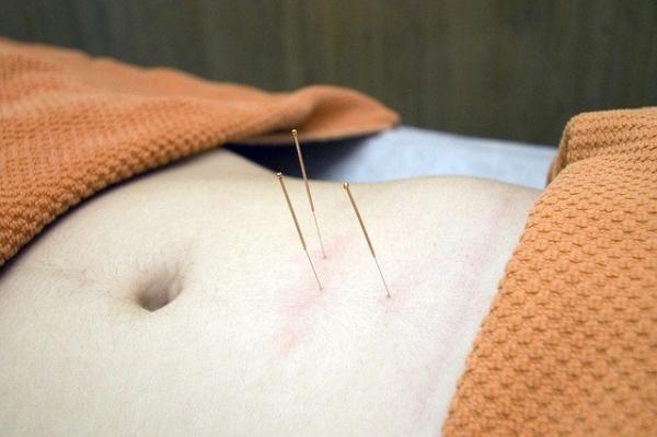 Il faut rappeler que l’acupuncture consiste en l’implantation d’aiguilles fines à la surface de la peau. Le choix des points se situe le long des méridiens, là où passe l’énergie. (Image : Alterio Felines / Pixabay) 
