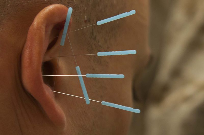 Les origines légendaires de l’acupuncture dans la médecine traditionnelle chinoise