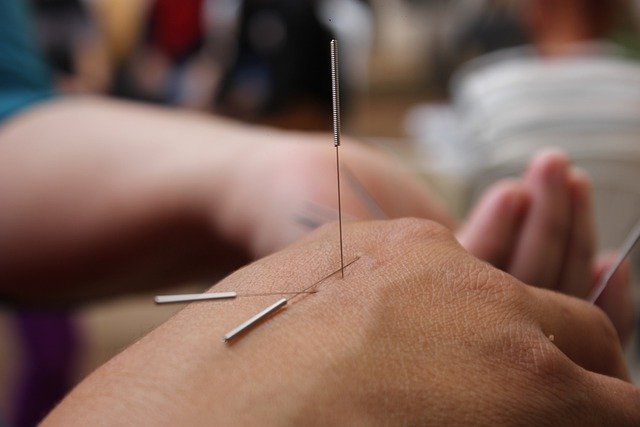 Les origines légendaires de l’acupuncture dans la médecine traditionnelle chinoise