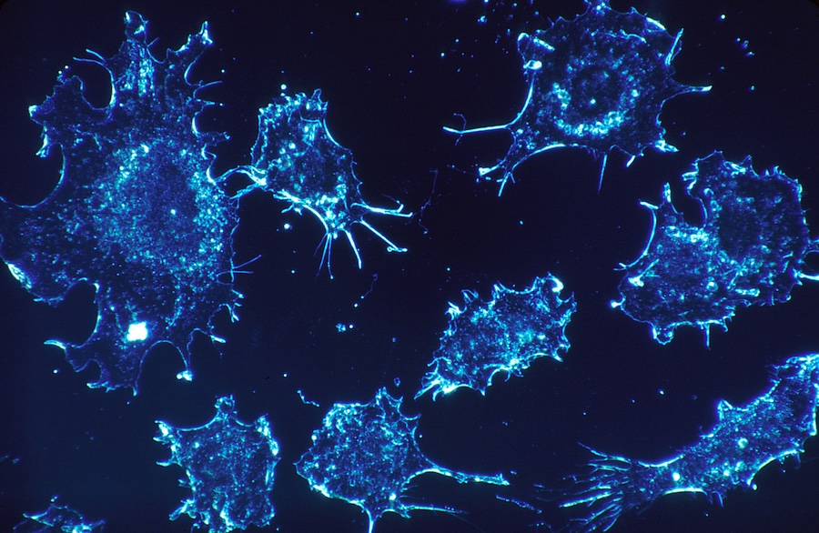 Le qi positif : intégrer l’esprit, le corps et l’âme pour vaincre le cancer