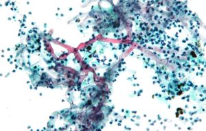 Le nombre de décès dus aux infections fongiques dans le monde a doublé en dix ans selon une nouvelle étude