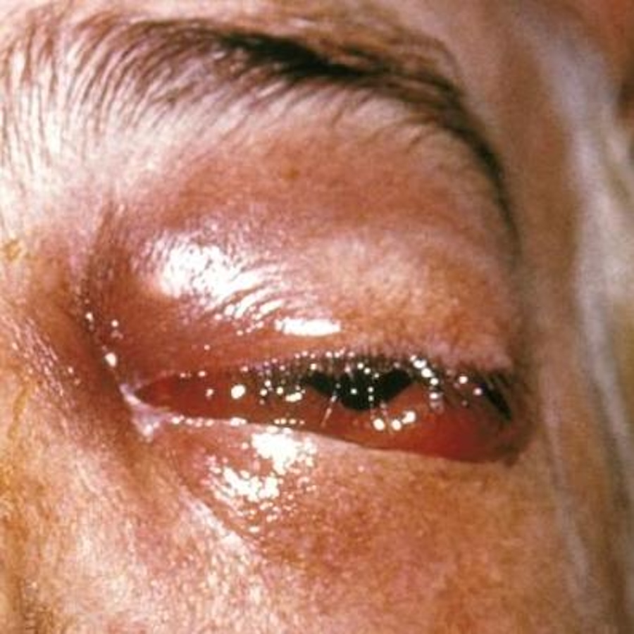 Le nombre de décès dus aux infections fongiques dans le monde a doublé en dix ans selon une nouvelle étude